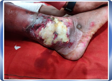 DIABETIC FOOT
